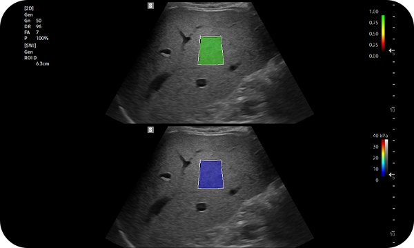  S-Shearwave Imaging™ : liver diagnosis Solutions