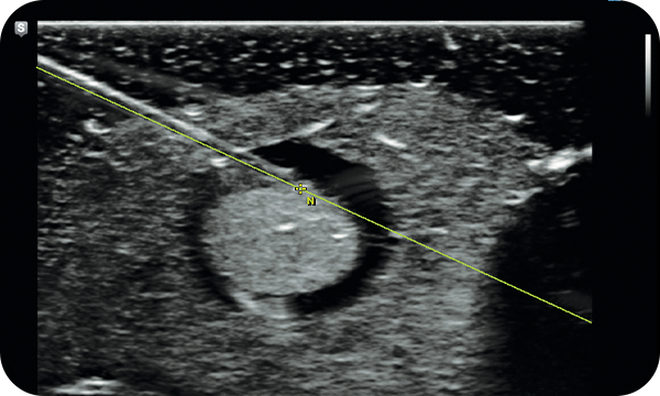 S Tracking for ultrasound needle guide