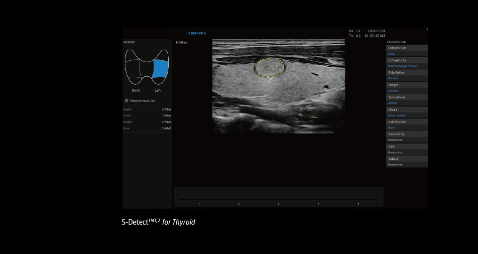 S-Detect™ ¹ for Thyroid