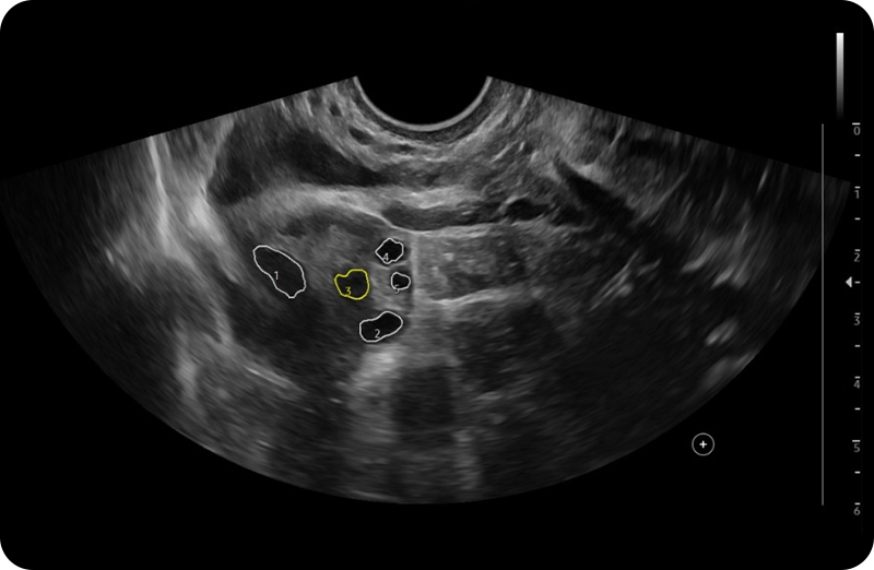 follicle assessment