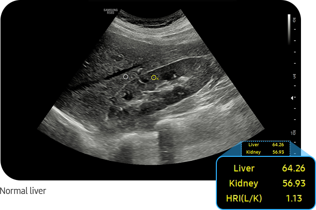 Normal liver