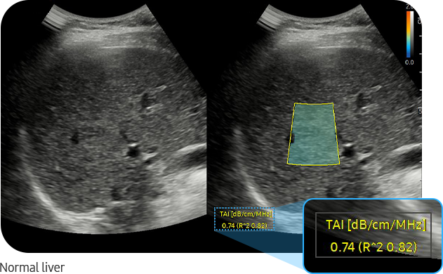 Normal liver