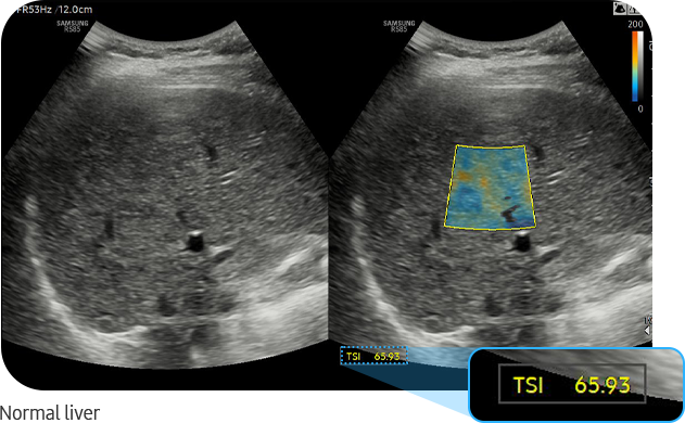 Normal liver