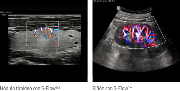 Nódulo tiroideo con S-Flow™, Riñón con S-Flow™