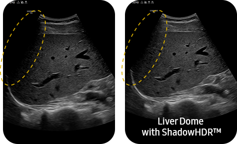 Liver Dome with ShadowHDR™