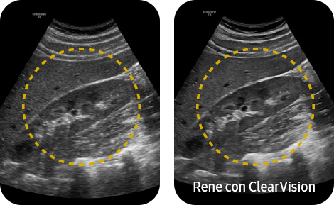Kidney with ClearVision