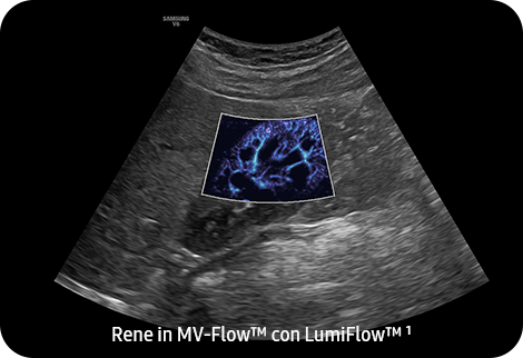 Kidney in MV-Flow™ with LumiFlow™ ¹