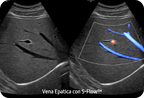 Hepatic Vein with S-Flow™