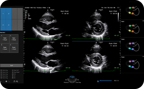 medical diagnostics : StressEcho 