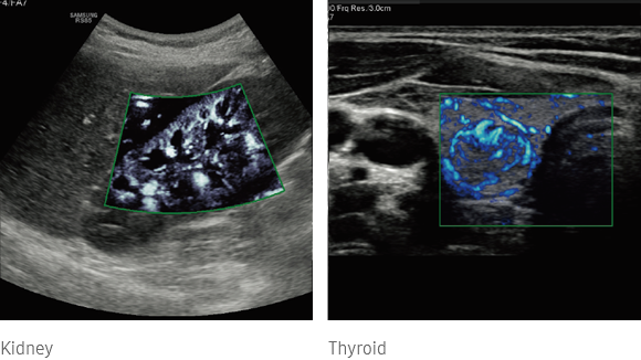 ultrasound doppler  : MV-Flow™