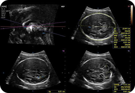 ob ultrasound tech: 5D CNS+™ 