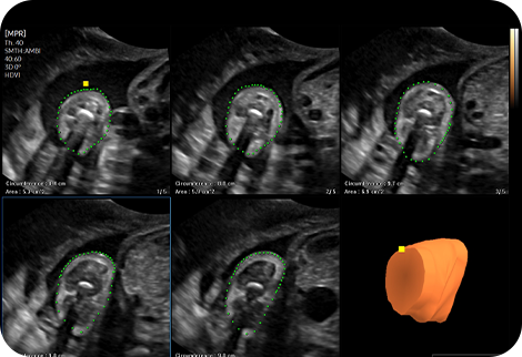 ob ultrasound tech: 5D Limb Vol.™